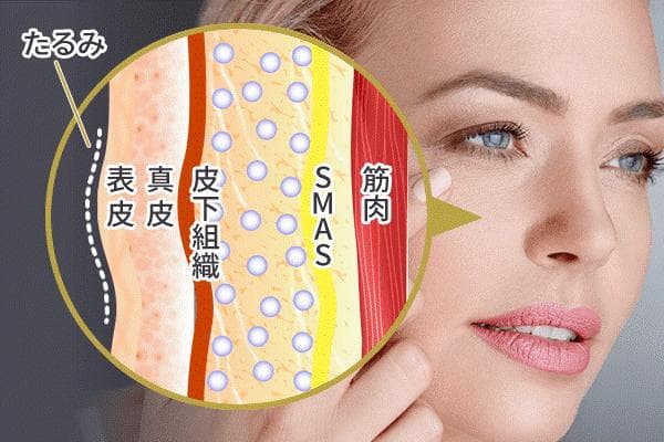 最新40.68MHzのRF高周波機器【シワ、たるみ、ほうれい線改善】220万円→