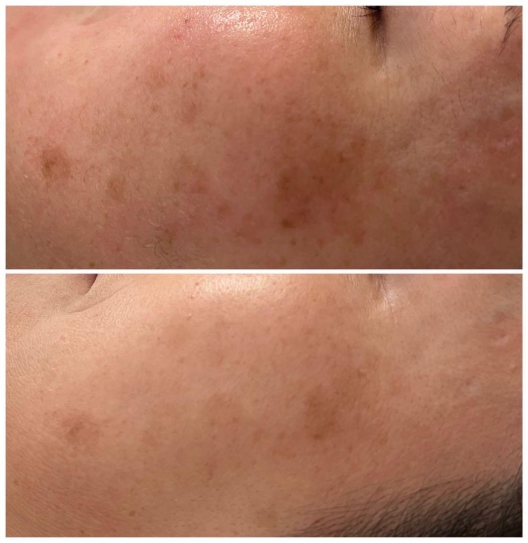 低周波ペンシル　シミケア機　リシルク　ReSilk セット販売