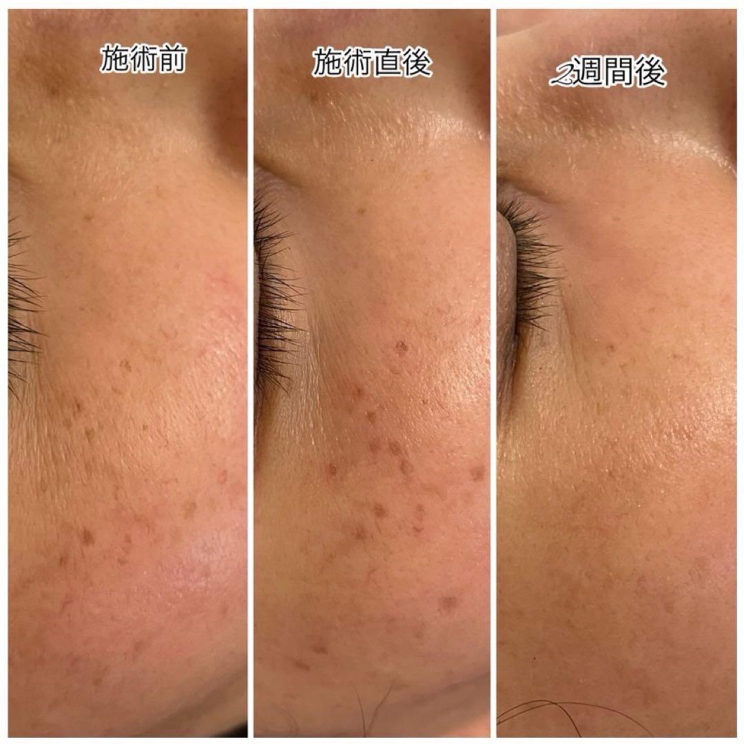 低周波ペンシル　シミケア機　リシルク　ReSilk セット販売