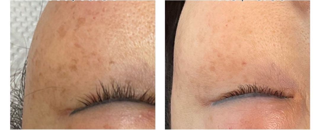 低周波ペンシル　シミケア機　リシルク　ReSilk セット販売