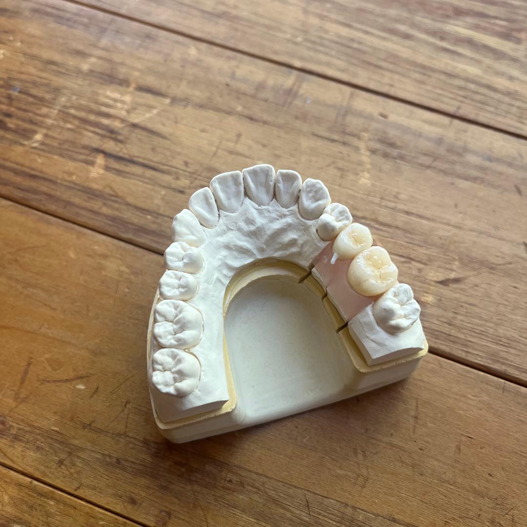 患者説明用模型 オールセラミック