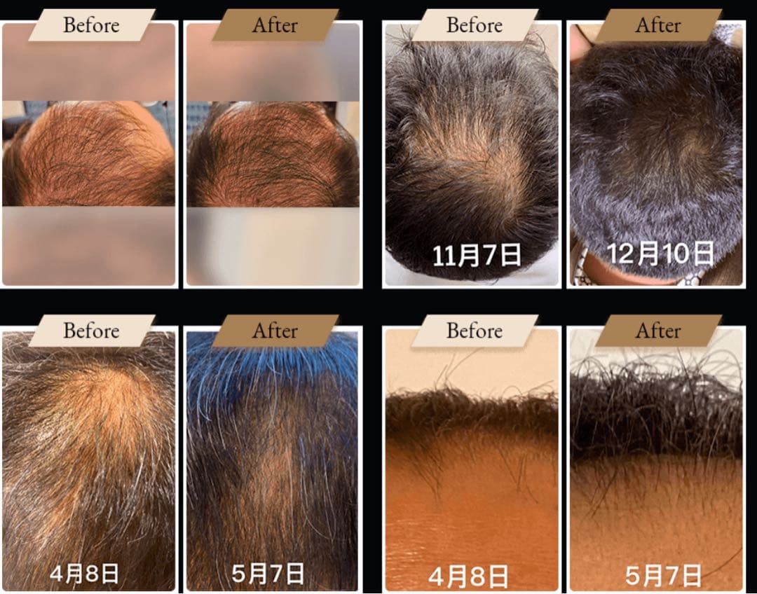 未使用！ナノスキンニードル エステ版ポテンツァ 水光ジェット 韓国肌管理◎