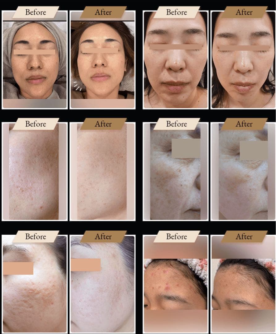 未使用！ナノスキンニードル エステ版ポテンツァ 水光ジェット 韓国肌管理◎