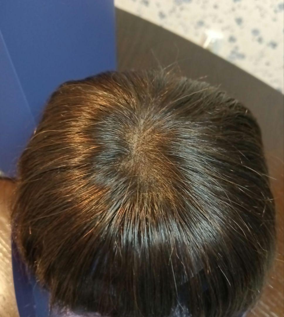 フォンテーヌ トップピース