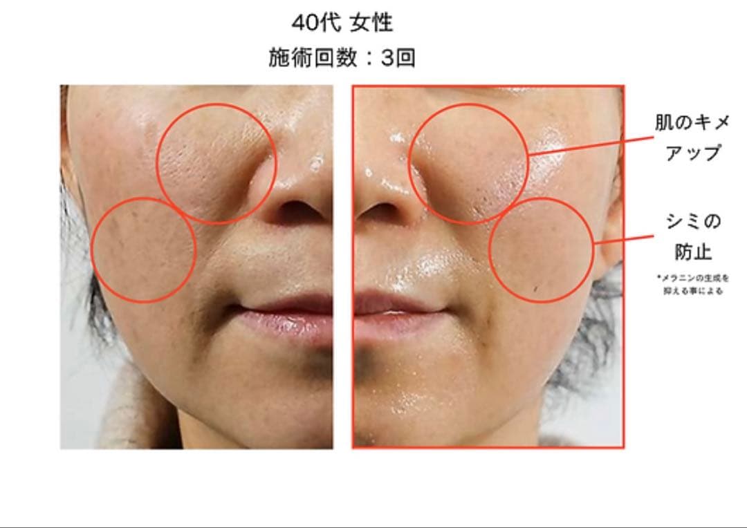 ★つむぎ　新ララピール　特別セット