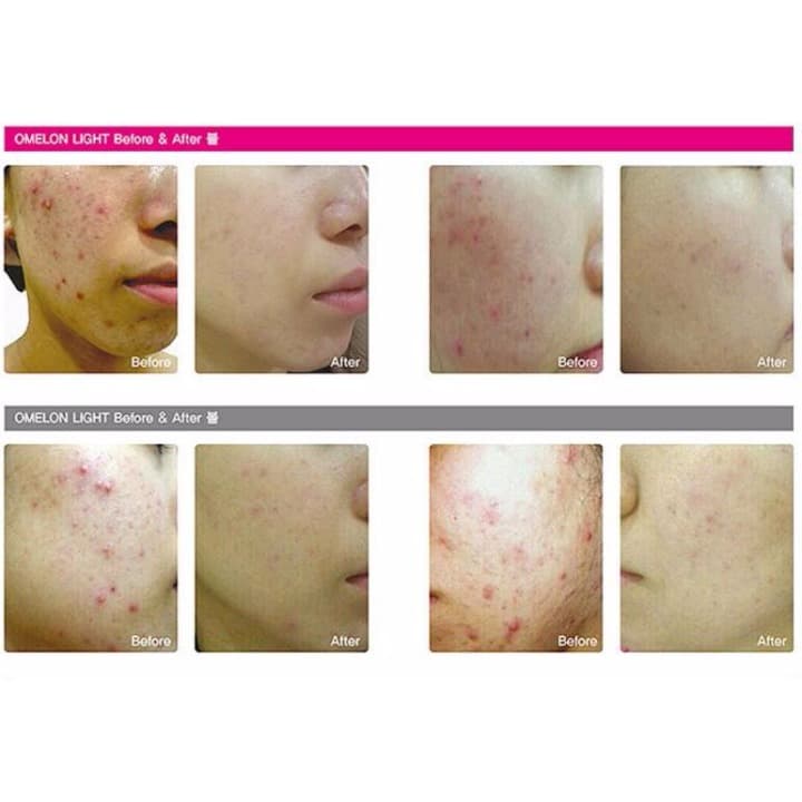 韓国大人気！LED美顔器 橋形 背中やお腹にも施術可能　しわ、ニキビ対策