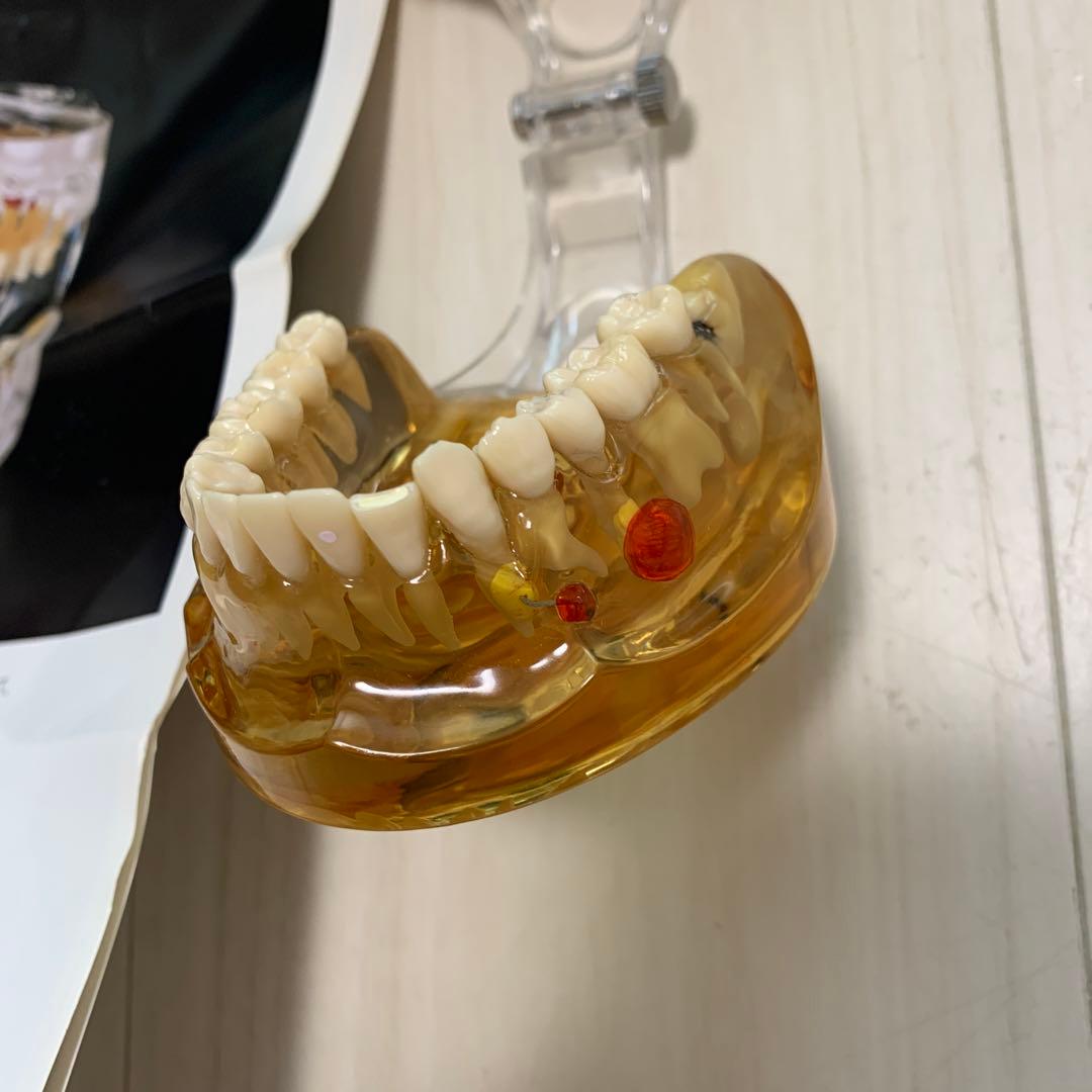 透明歯牙疾患模型