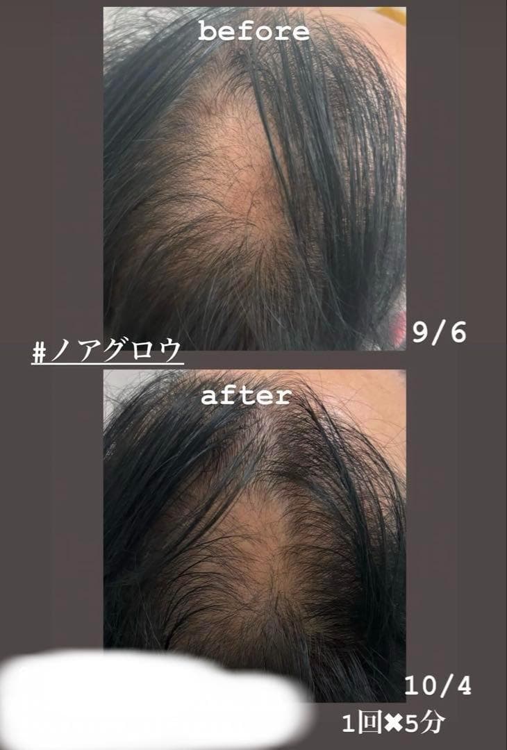 ドクタービセア 美容液導入 MTS ノアグロウ同型＋チップ14個+スカルプケア