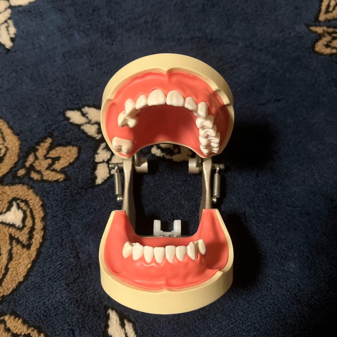 歯牙模型 補綴 歯科 下顎遊離端欠損